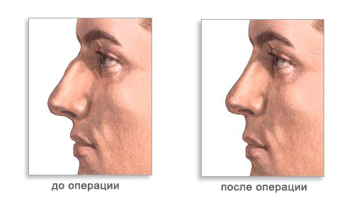 Коррекция формы носа (ринопластика)