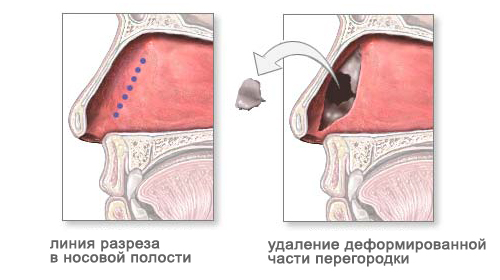 Коррекция носовой перегородки (септопластика)