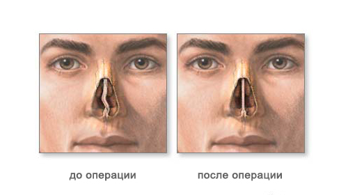 Коррекция носовой перегородки (септопластика)